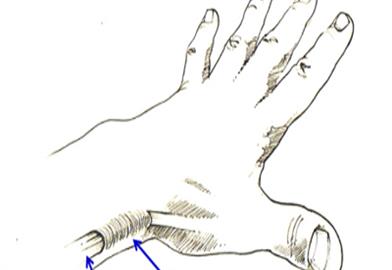 Hand Conditions | The British Society for Surgery of the Hand