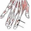 Hand Injuries | The British Society for Surgery of the Hand